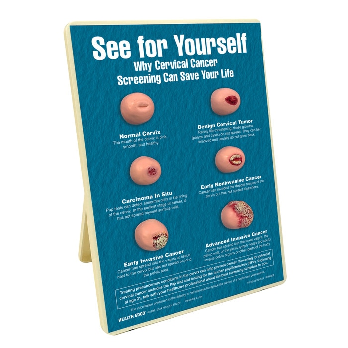 See for Yourself: Why Cervical Cancer Screening Can Save Your Life Easel Display, health models of cervices, Health Edco, 79733