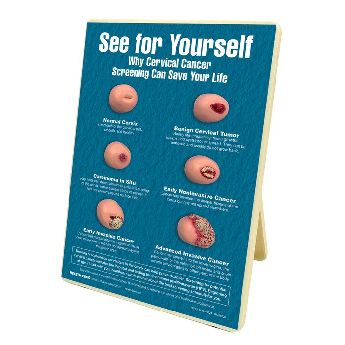 See for Yourself: Why Cervical Cancer Screening Can Save Your Life Easel Display, health models of cervices, Health Edco, 79733
